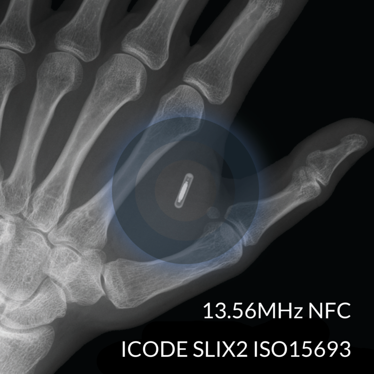 xSLX NFC implant